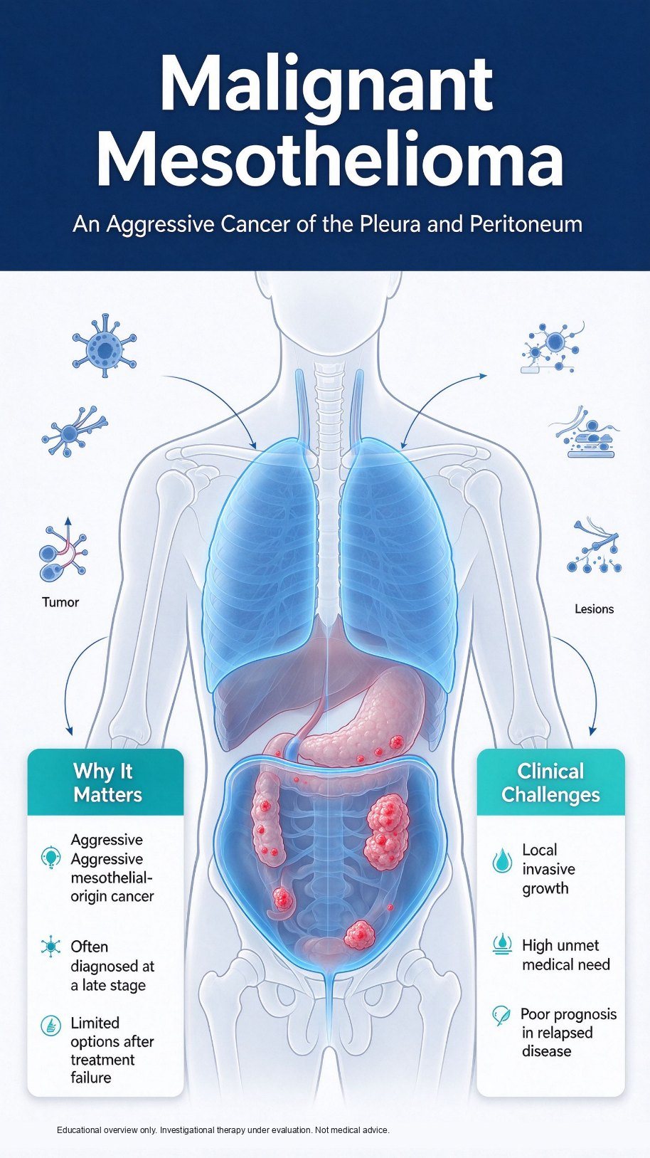 Malignant mesothelioma arises from the pleura or peritoneum, is often found late, and has limited options after standard treatment fails